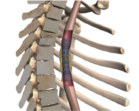 segmented stent