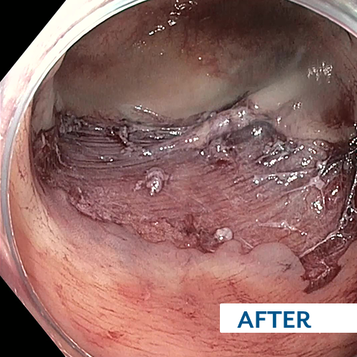 after EndoRotor Endoscopic Powered Resection