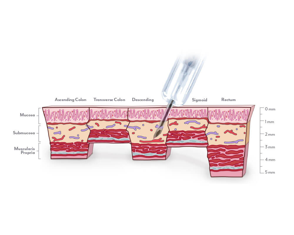 Pinpoint Needle illustration